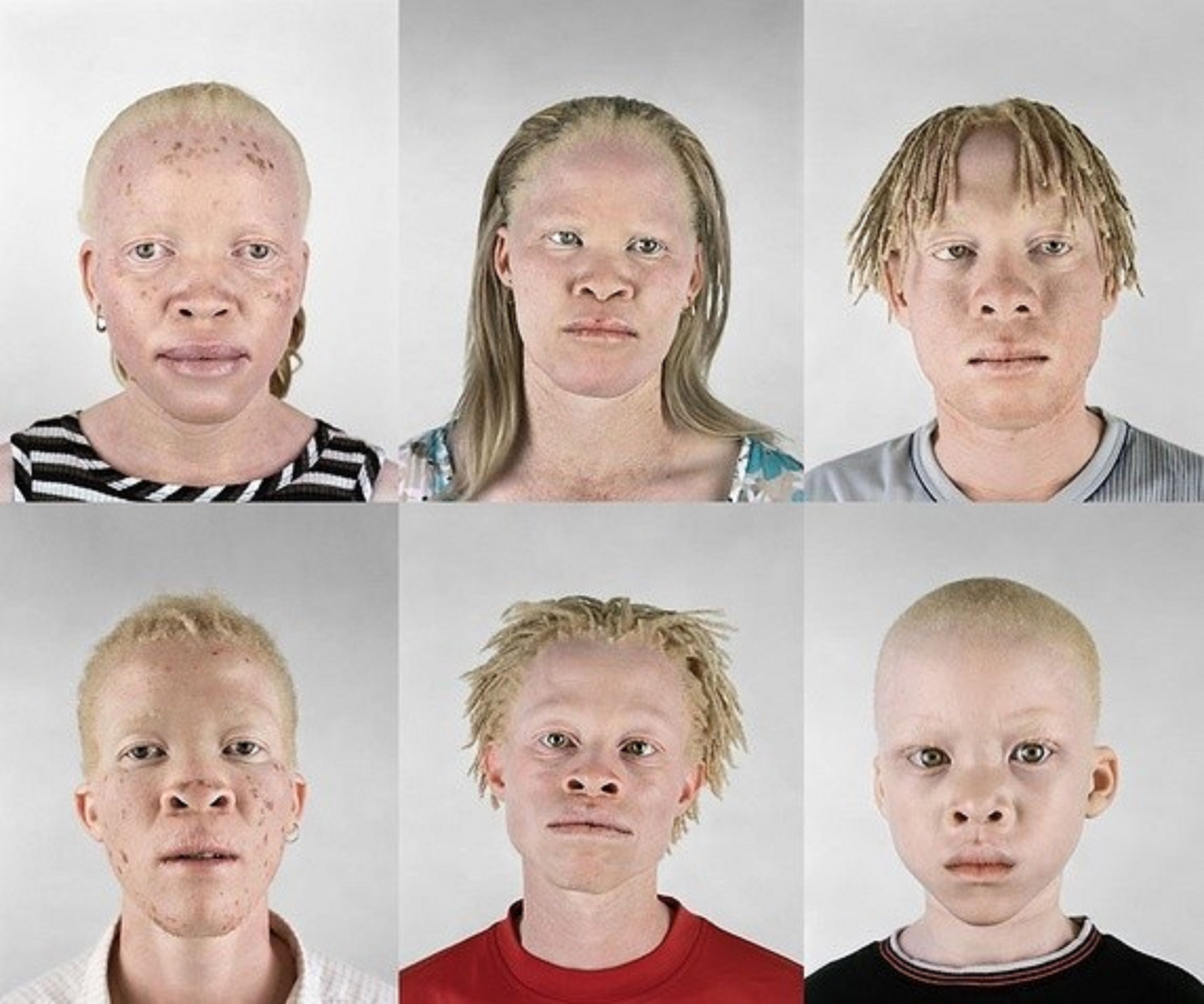 Частичный альбинизм у человека
