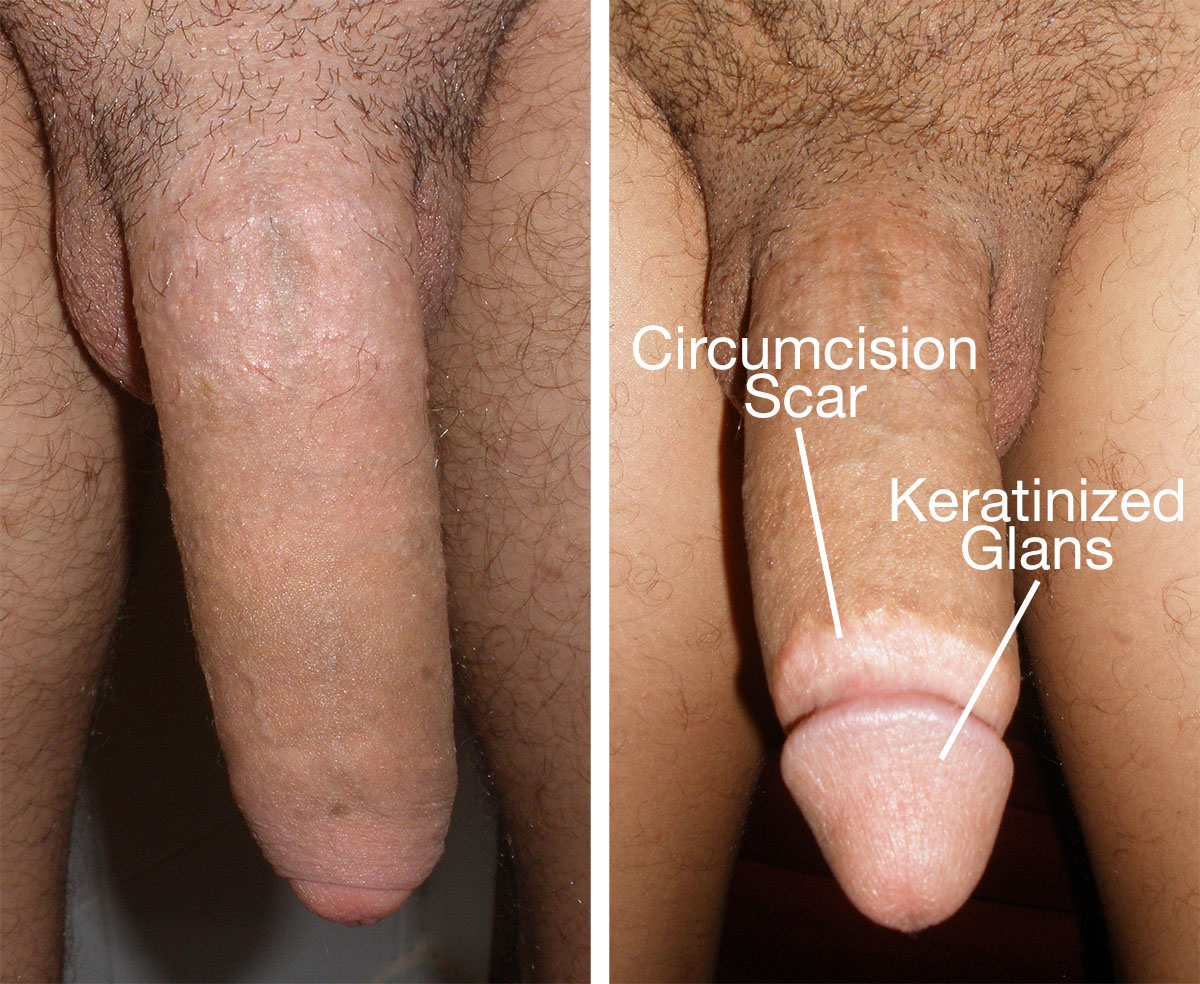 How different does sex feel circumcised vs uncircumcised - M