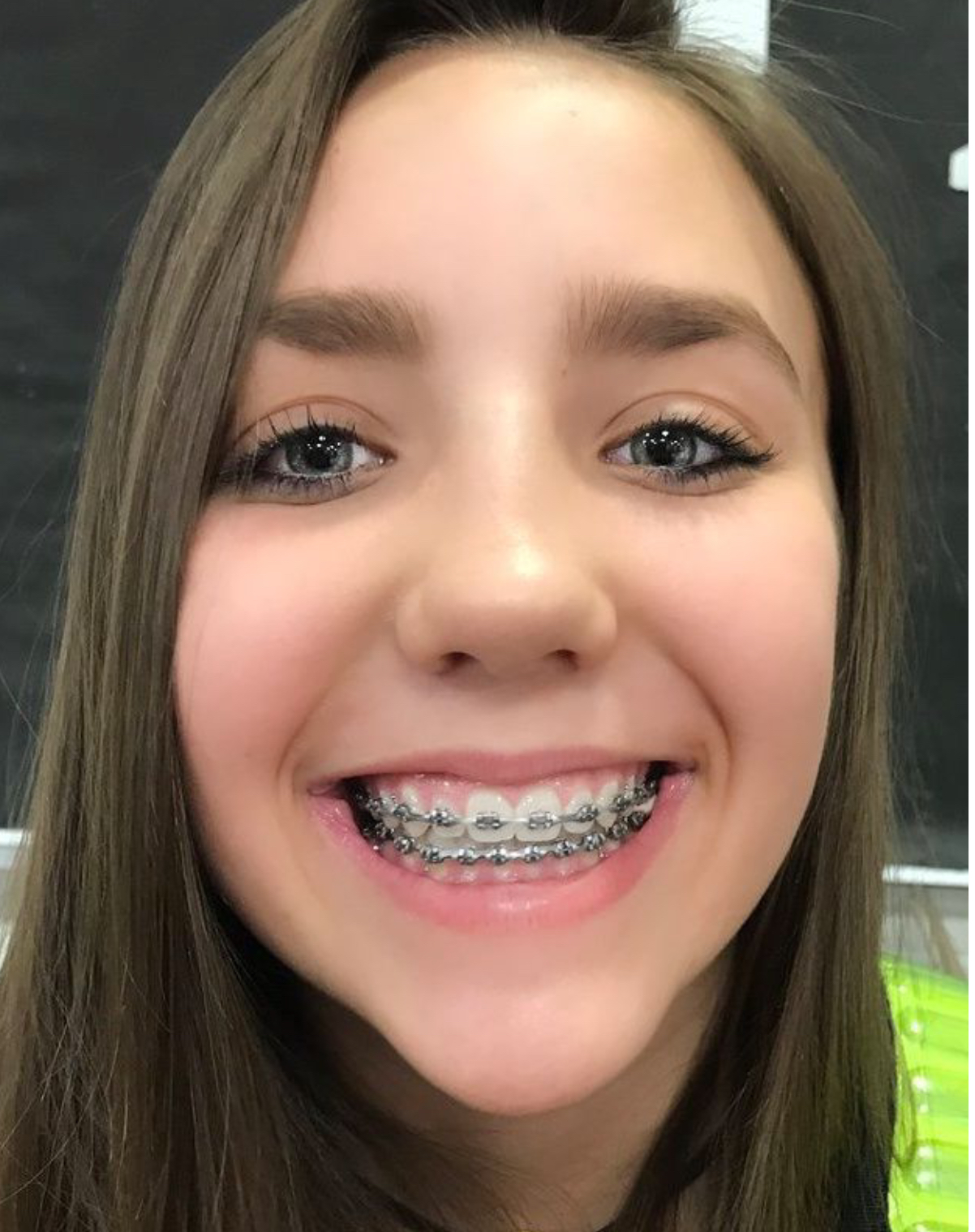 Cute Girls Braces