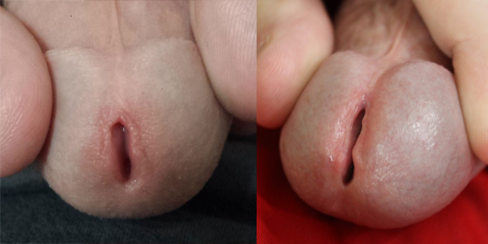 Meatotomy Pics